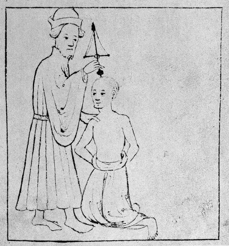Trepanation to release spirits