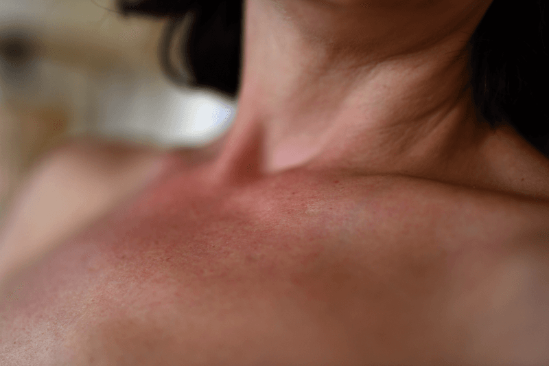 Cervical Artery Dissection After Neck Manipulation