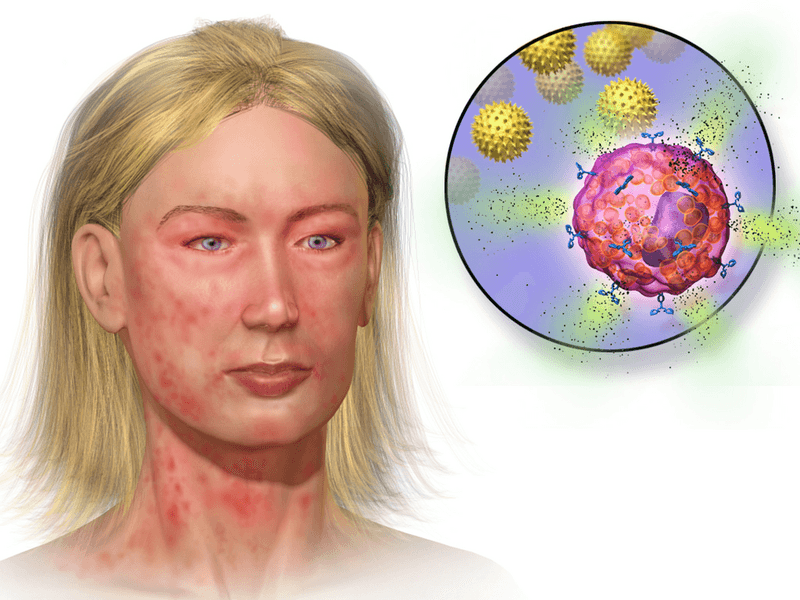Cold-Induced Anaphylaxis