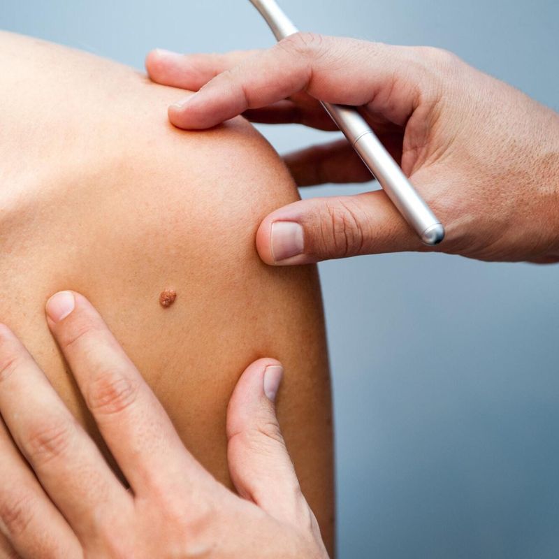 Birthmarks Reveal Events from a Past Life