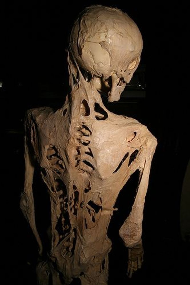 Fibrodysplasia Ossificans Progressiva (Stone Man Syndrome) Fibrodysplasia Ossificans Progressiva (Stone Man Syndrome)