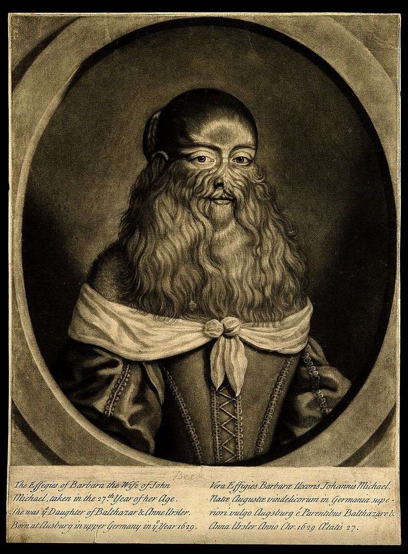 Hypertrichosis (Werewolf Syndrome) Hypertrichosis (Werewolf Syndrome)