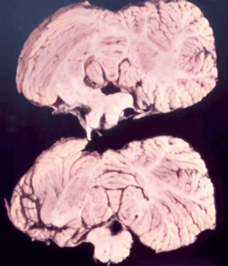 Kuru Disease Kuru Disease