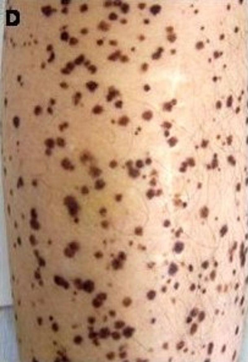 Leopard Syndrome (Noonan Syndrome with Multiple Lentigines) Leopard Syndrome (Noonan Syndrome with Multiple Lentigines)