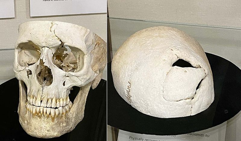 Phineas Gage's Skull - Boston, Massachusetts Phineas Gage's Skull - Boston, Massachusetts