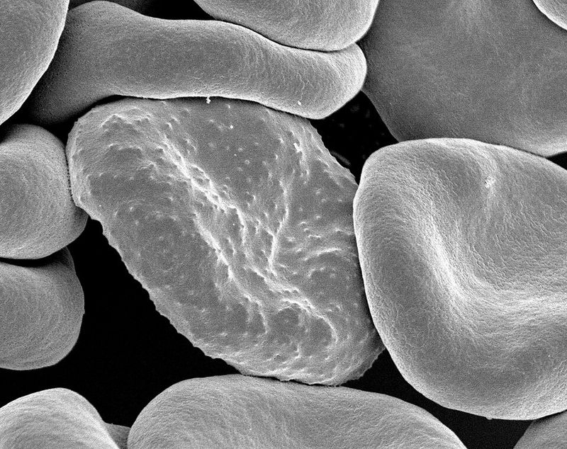 Malaria Malaria