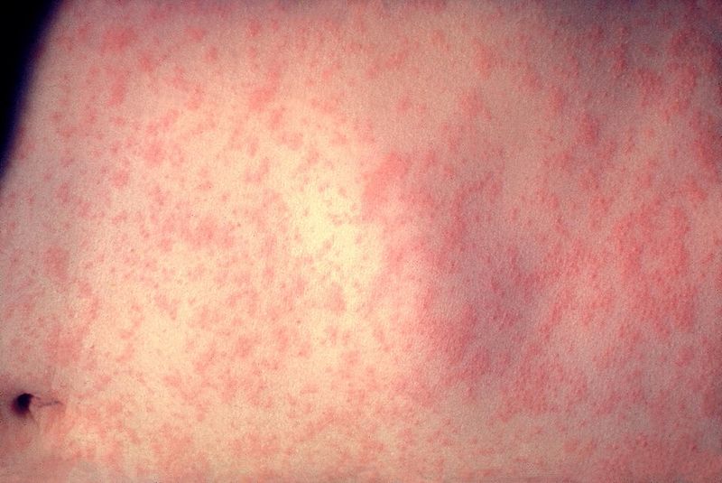 Measles Measles
