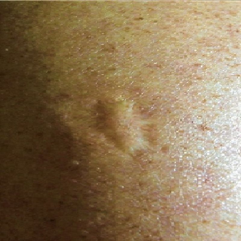 Smallpox Smallpox