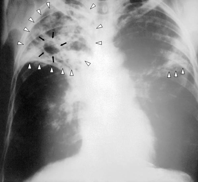 Tuberculosis Tuberculosis