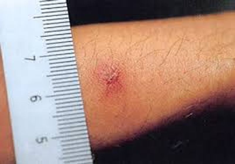 Typhus Typhus